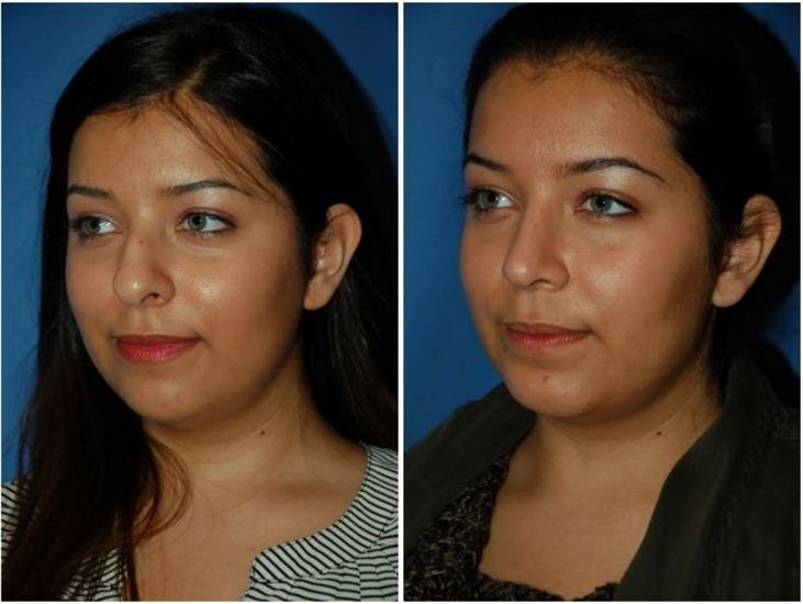 best rhinoplasty surgeon seattle wa